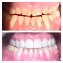 Downers Dental - Teeth wear treatment!!