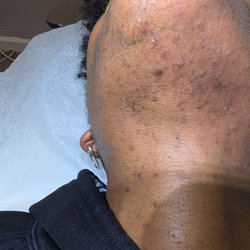 O Neal Elite Electrolysis