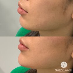 Norah Clair Aesthetics - Chin augmentation with filler!