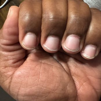 Be Be Nails & Permanent Makeup - Nails after soak off index finger has a cut across with a wound other finger shows how indentation along the top of the cuticles. - Nail Salons Near Me - Modesto, California Be Be Nails & Permanent Makeup - Nails after soak off index finger has a cut across with a wound other finger shows how indentation along the top of the cuticles. - Nail Salons Near Me - Modesto, California