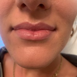 Cosmetic Injections by Sarah - Before