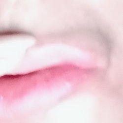 Salt Lake City Botox and Fillers - Huge bulge on left upper lip corner due to filler migration.   Caused 'shelf' across front lip.  These are horribly 'botched lips' .