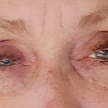 Pacific Eye Associates - Eyes before surgery August 24 2021 - Ophthalmologists Near Me - San Francisco, California Pacific Eye Associates - Eyes before surgery August 24 2021 - Ophthalmologists Near Me - San Francisco, California