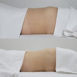 Bodyby_emilyg - 3 month difference - weekly lymphatic along with daily exercise