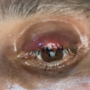 Roya Ghafouri, MD - Post surgery. Little puffy one day after. But healing nicely. - Ophthalmologists Near Me - Beverly hills, California Roya Ghafouri, MD - Post surgery. Little puffy one day after. But healing nicely. - Ophthalmologists Near Me - Beverly hills, California