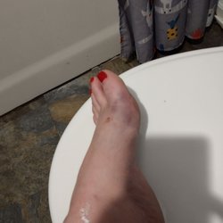 Fractured big toe and bruised