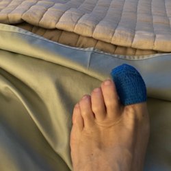 S.I. Podiatry: Richard A. Rouder, DPM, PC - Ingrown toenail