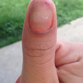Cali Nails - Post nail removal. - Nail Salons Near Me - Fort Wayne, Indiana