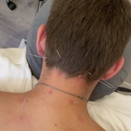 Acupuncture the first time... Acupuncture the first time...