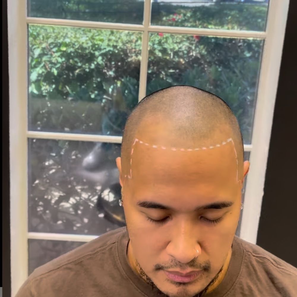 Scalp Micro SD - Before with receding hairline and hair loss - Permanent Makeup Near Me - San Diego, California Scalp Micro SD - Before with receding hairline and hair loss - Permanent Makeup Near Me - San Diego, California