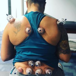Brooklyn Body Works Physical Therapy PC - Some cupping to help improve soft tissue mobility thus improving larger pain free active range of motion (AROM).