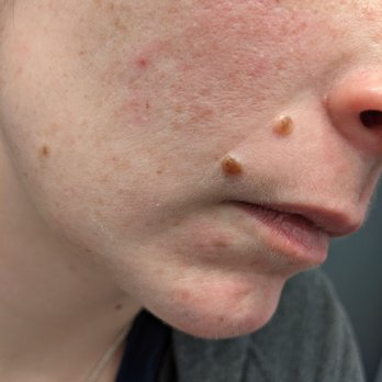Holiday Inn Express & Suites Leander - Rash that developed after the second night - Hotels Near Me - Leander, Texas Holiday Inn Express & Suites Leander - Rash that developed after the second night - Hotels Near Me - Leander, Texas