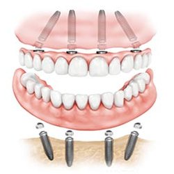 Westchester Oral and Maxillofacial Associates - Teeth-in-a-Day All on Four Implants