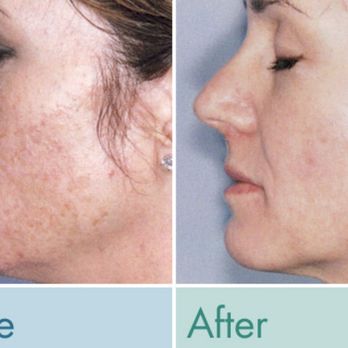 Laser Technique Medical Spa - Elos IPL photorejuvenation with RF - Medical Spas Near Me - Webster, Texas Laser Technique Medical Spa - Elos IPL photorejuvenation with RF - Medical Spas Near Me - Webster, Texas