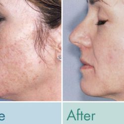 Laser Technique Medical Spa - Elos IPL photorejuvenation with RF
