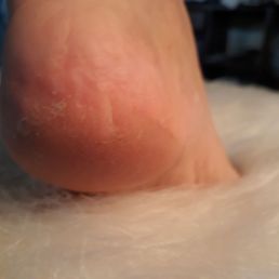 Still have dead skin