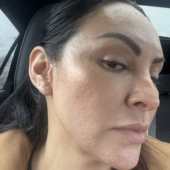 Biorevive Jersey City - 4th day, even skin tone, hydrated, and smaller pores. love!!!!! - Medical Spas Near Me - Jersey City, New Jersey Biorevive Jersey City - 4th day, even skin tone, hydrated, and smaller pores. love!!!!! - Medical Spas Near Me - Jersey City, New Jersey