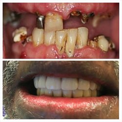 Gauri Madaan - Santa Teresa Family Dental - Before and After