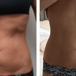Monaco MedSpa - Morpheus8 Abdomen, By Dr. Barrueta, Before & 6 Days After, One Treatment Session