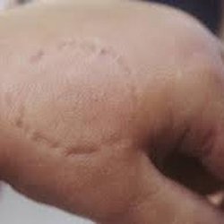 Therapeutic Solutions - Where doctor aboesh bit me for some fking reason ?? I asked if I could try lexapro?