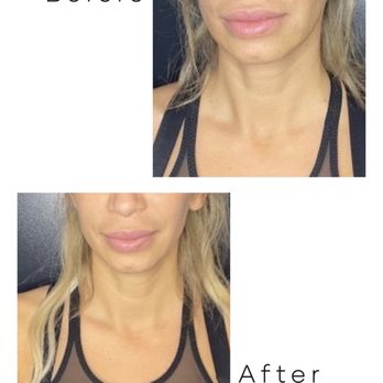 Plump Medical Spa - Before and after nasolabial folds - Medical Spas Near Me - Newport Beach, California Plump Medical Spa - Before and after nasolabial folds - Medical Spas Near Me - Newport Beach, California