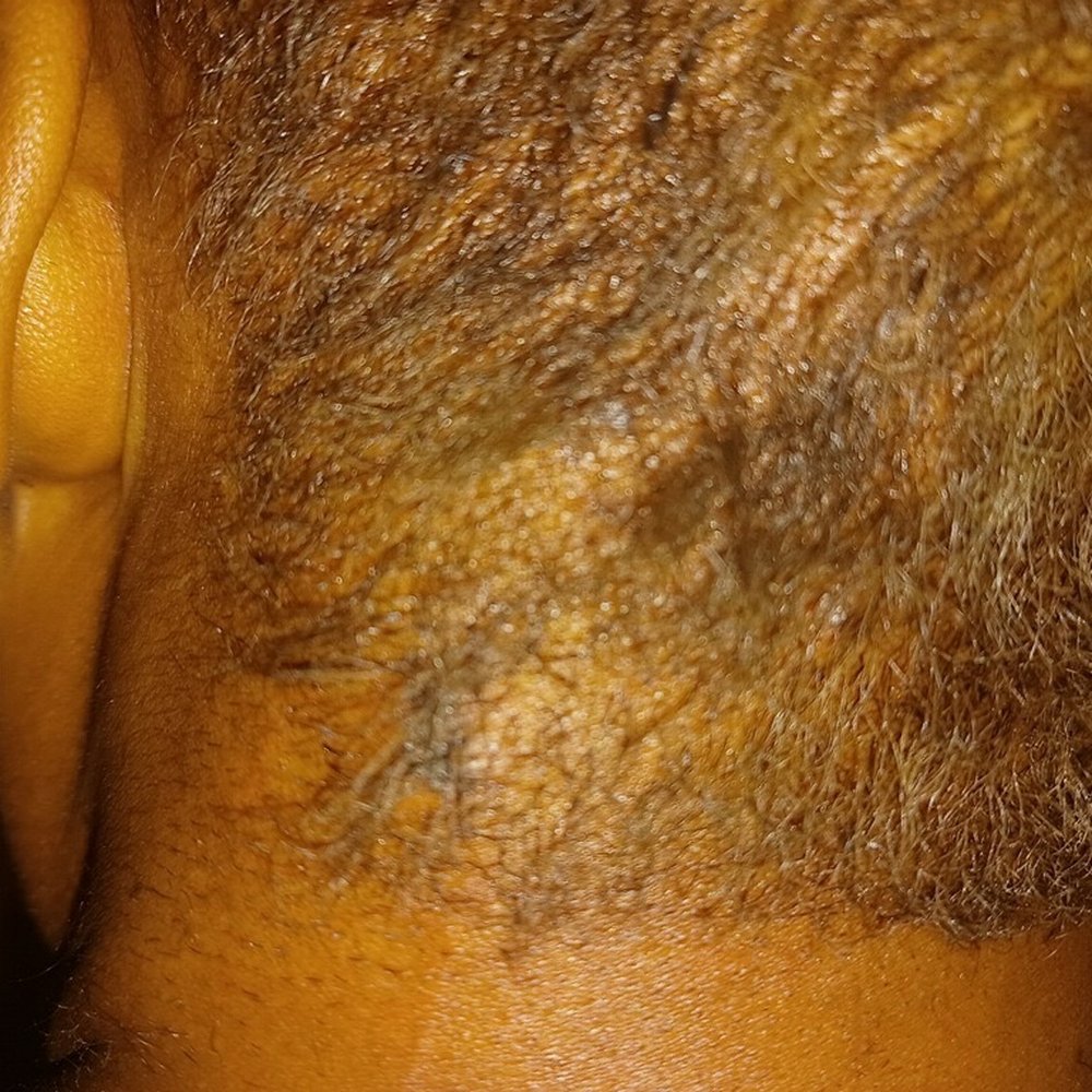 Lower left at the nape, burn Lower left at the nape, burn