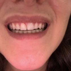 Millennium Family Dental - My teeth after dental bonding fell off(new gap I never had before)