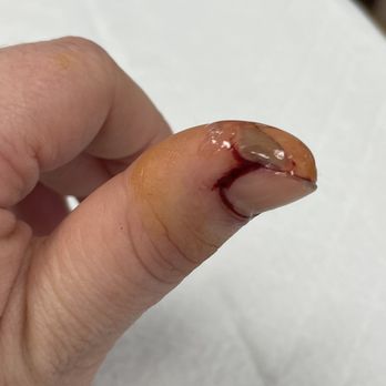 Concentra Urgent Care - Glue??... how about some stitches doc... - Occupational Therapy Near Me - Boca Raton, Florida Concentra Urgent Care - Glue??... how about some stitches doc... - Occupational Therapy Near Me - Boca Raton, Florida
