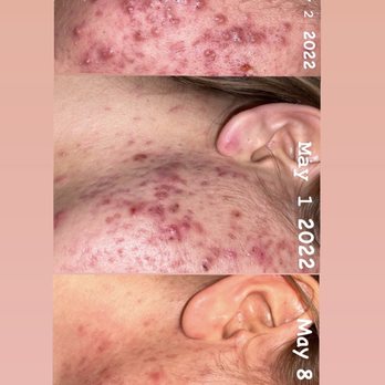 Starkiv Beauty - Results - Estheticians Near Me - Citrus Heights, California Starkiv Beauty - Results - Estheticians Near Me - Citrus Heights, California