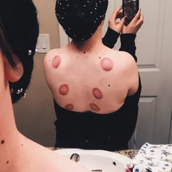 Soft Touch Wellness - Cupping marks