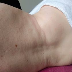 Karmic Grace - Before Neveskin treatment