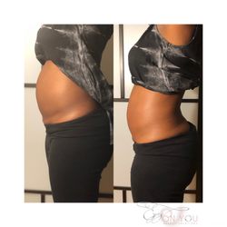 Eyez On You Beauty Solutions - Lipocavitation before and after 1st session.