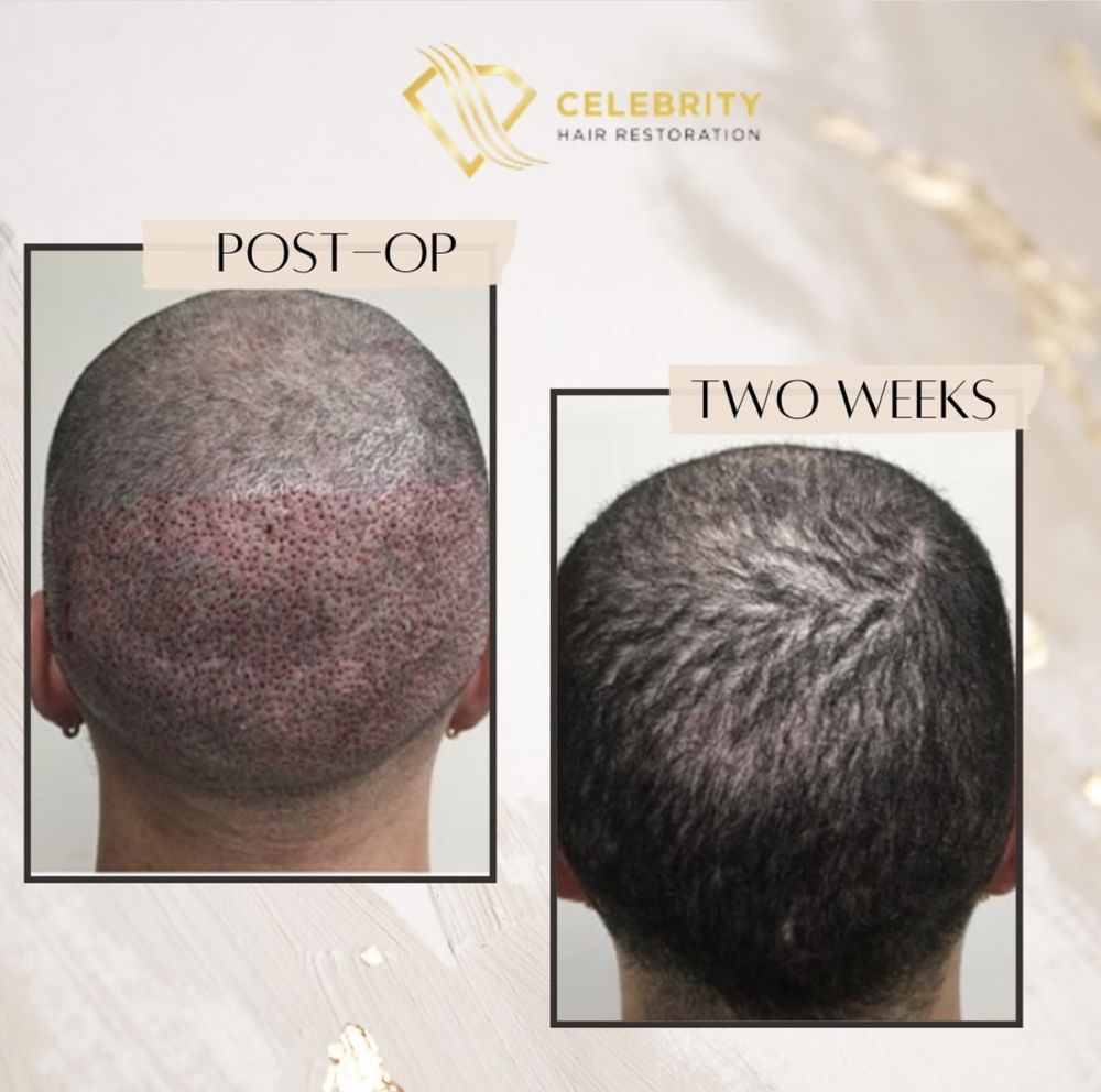 CELEBRITY HAIR RESTORATION Updated October 2024 42 Photos 6858