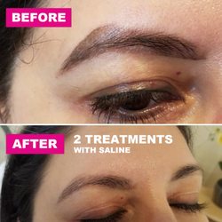 Carol Packman - Top picture is before removal and bottom picture is after 2 saline removal treatments. She has lost a lot of pigment.