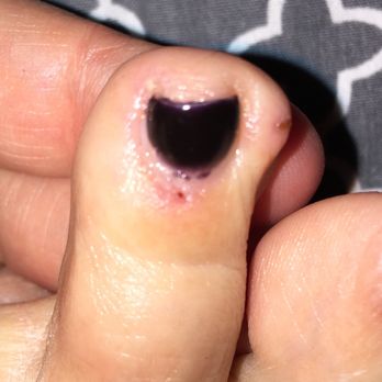 Pamper Me Nail Spa - 16 days after my pedicure and I still have infected scabs from the callous remover gel that was put all over the top of my toes. - Nail Salons Near Me - Mesa, Arizona