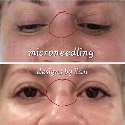 Microneedling Before/After - Contact us today for your microneedling service! Microneedling Before/After - Contact us today for your microneedling service!