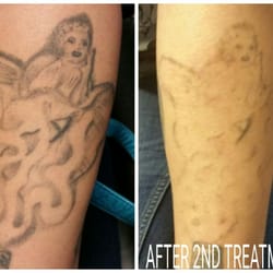 Milwaukee Laser Tattoo Removal