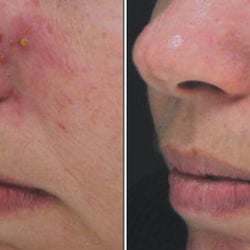 Clear Skin Laser - Acne Clearing