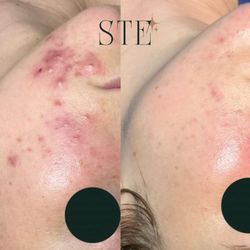 Skin Therapy by Erica K. - Before and after my client who went through my Integrative Acne Program