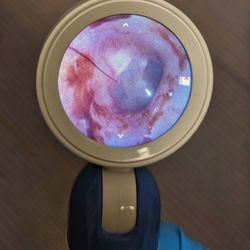 Ascent Audiology & Hearing - Fort Lauderdale - After: right ear wax removal