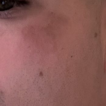 Thera-Red - Skin after accident - Saunas Near Me - Irvine, California