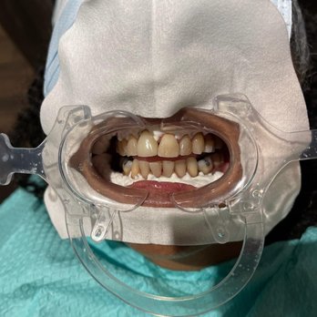 Buckhead Dental Center - Before - General Dentistry Near Me - Atlanta, Georgia