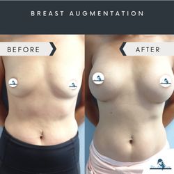 Anh Lee Plastic Surgery - Breast Augmentation