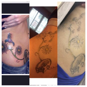 Skin Deep Laser Medspa - Tattoo removal: 1st photo was when I first got it 5 yrs ago, 2nd is a few treatments in, 3rd is right before my 7th treatment. - Skin Care Near Me - Pasadena, California Skin Deep Laser Medspa - Tattoo removal: 1st photo was when I first got it 5 yrs ago, 2nd is a few treatments in, 3rd is right before my 7th treatment. - Skin Care Near Me - Pasadena, California