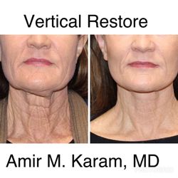 Amir M. Karam, M.D - Surgical neck rejuvenation