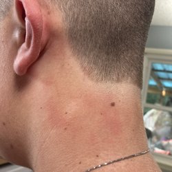 Hair by Alicia at Posh Salon - Razor burn from clipper 30 minutes after haircut.