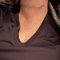 Alexander Shifrin, MD FACS FACE - 8 days after surgery