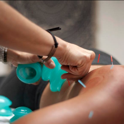 The Healing Well - Acupuncture and cupping
