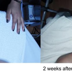 Esperanza Esthetics - Before & After Green Peels With Edie
