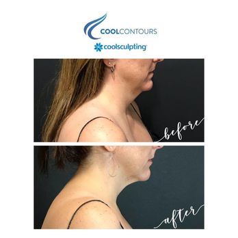 Cool Contours - You can eliminate that stubborn area under your chin with CoolSculpting. - Body Contouring Near Me - Fairfax, Virginia Cool Contours - You can eliminate that stubborn area under your chin with CoolSculpting. - Body Contouring Near Me - Fairfax, Virginia